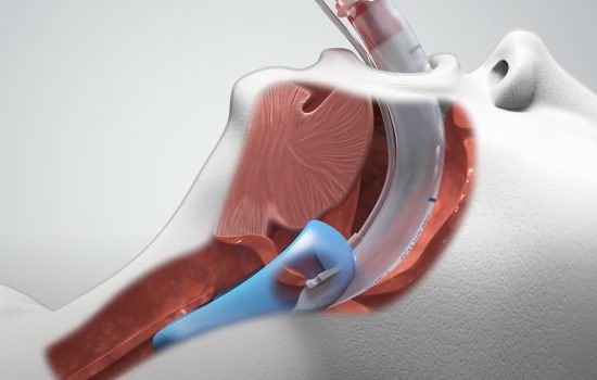 Air Q3 Insertion Diagram