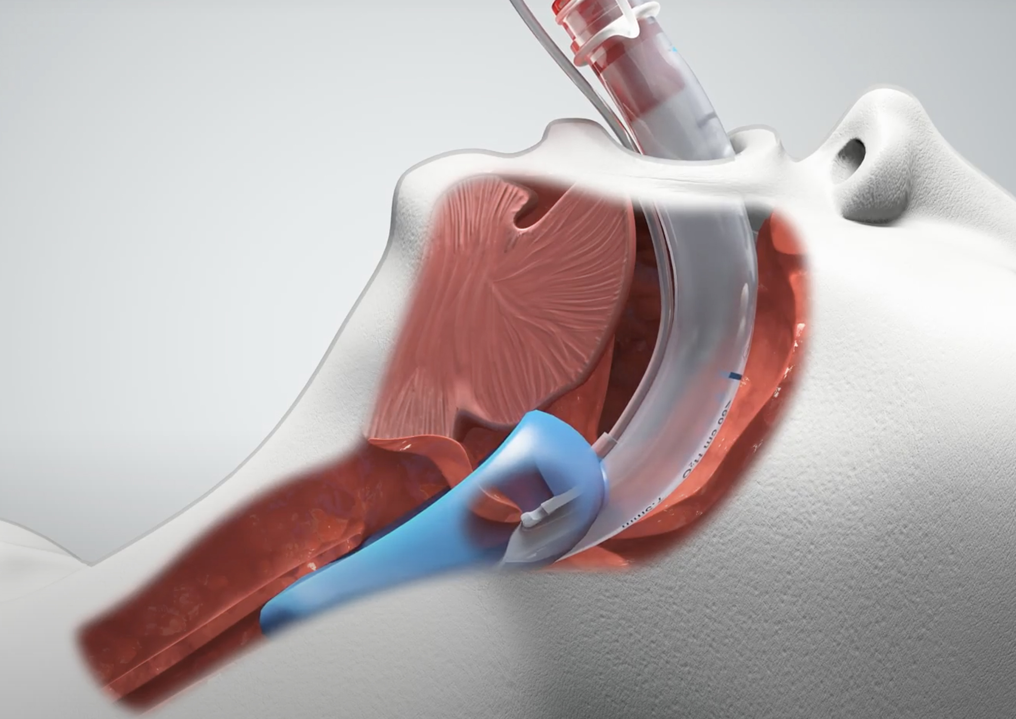 Air Q3 Insertion Diagram